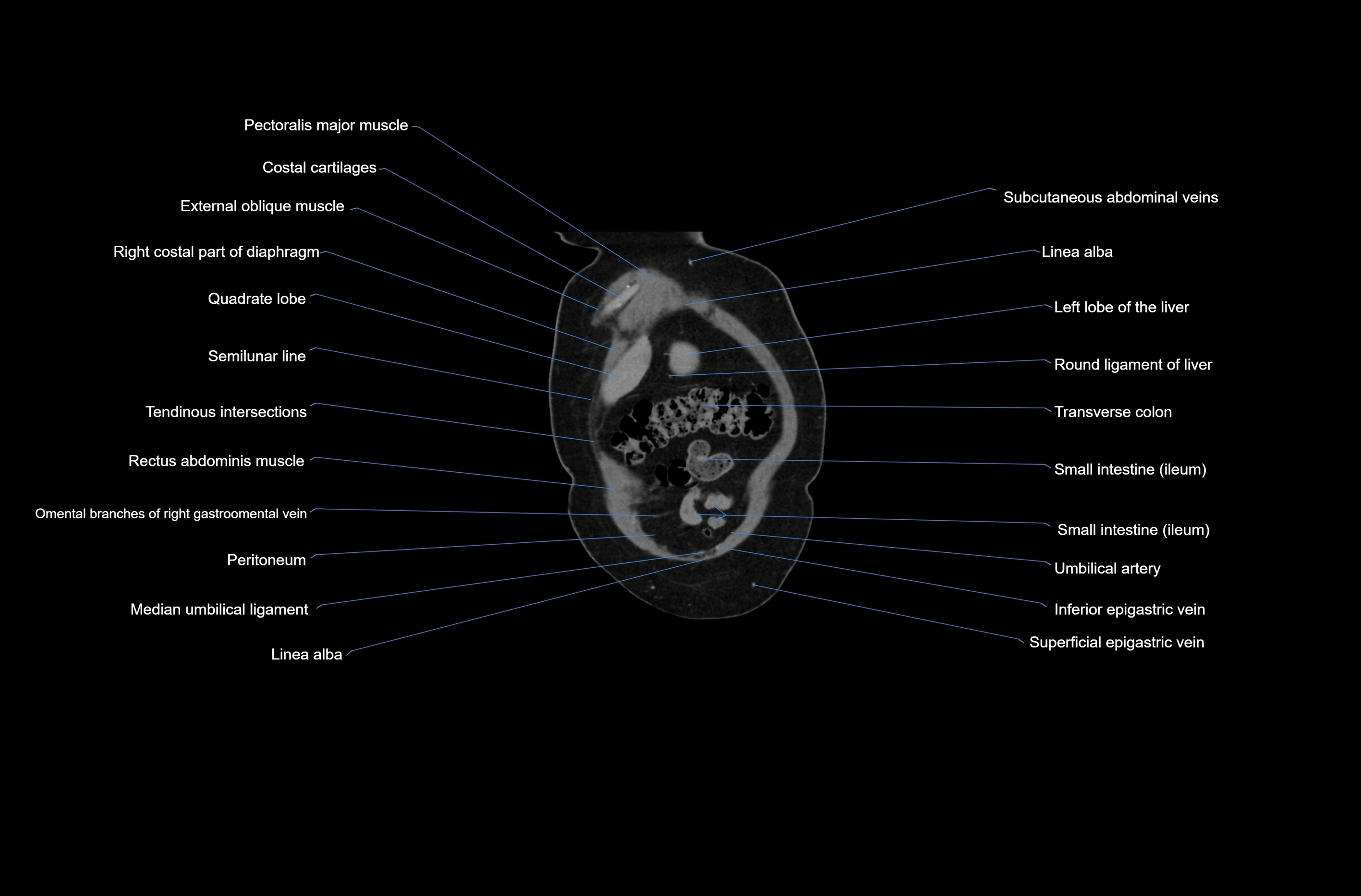 CT abdomen coronal cross sectional anatomy labelled radiology image-00010.webp
